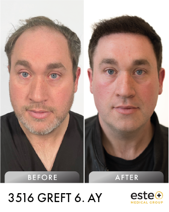 saç ekimi öncesi sonrası