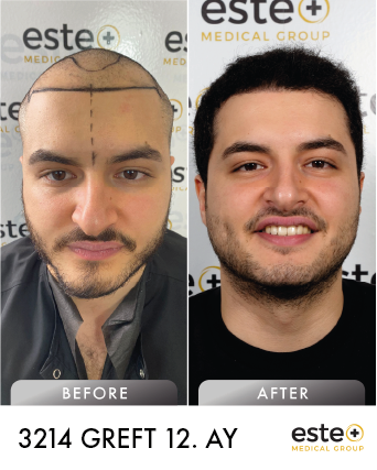 saç ekimi öncesi sonrası