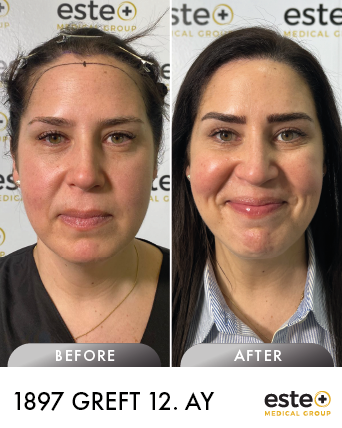 kadın saç ekimi öncesi sonrası