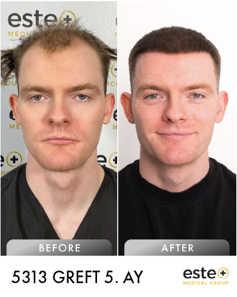 dhi öncesi sonrası