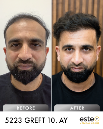 saç ekimi öncesi sonrası