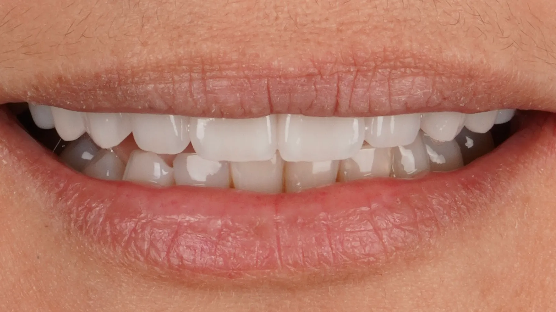 Nahaufnahme eines Lächelns mit Non-Prep-Veneers