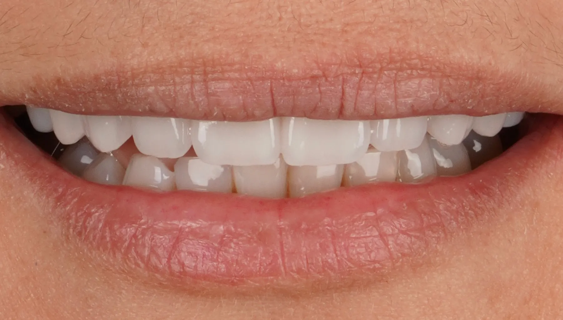 Nahaufnahme eines Lächelns mit Non-Prep-Veneers
