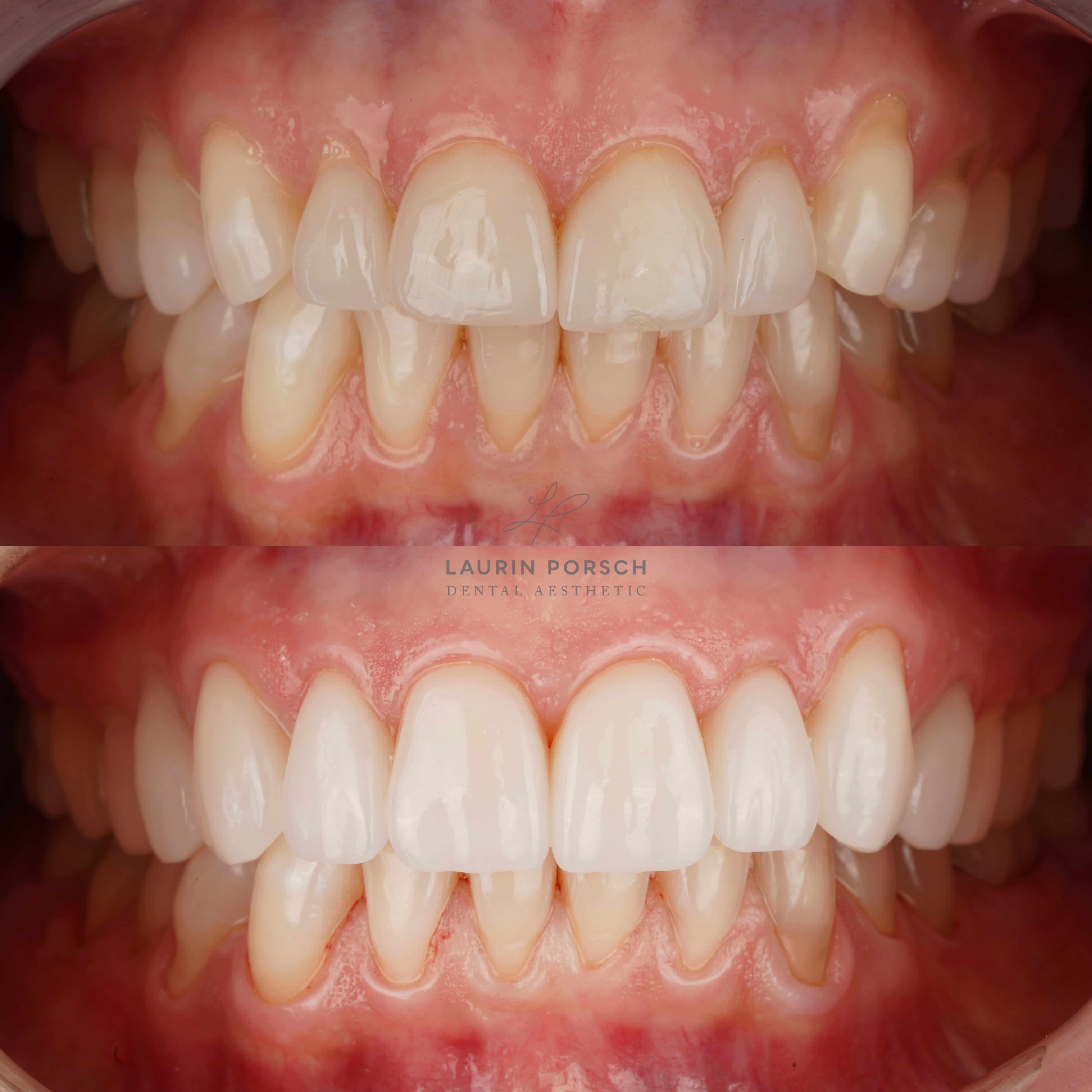 Zahnästhetik auf höchstem Niveau mit Veneers von Porsch Aesthetic in Frankfurt.