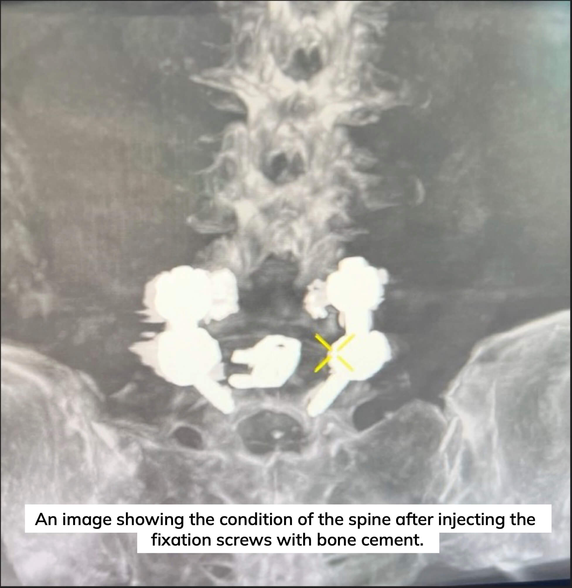 Minimally Invasive Surgery Ends Octogenarian Patient's Back Pain at Dr. Soliman Fakeeh Hospital