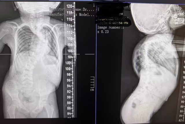 Exceptional Surgical Success for a Child with Severe Spinal Deformity
