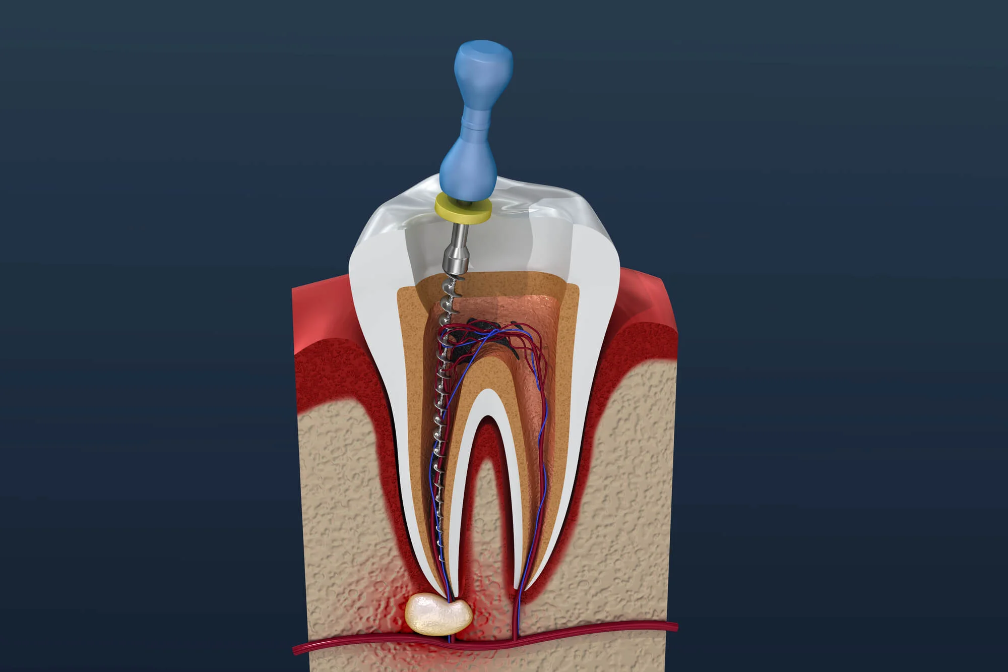 Root canal treatment – Knoxville root canal