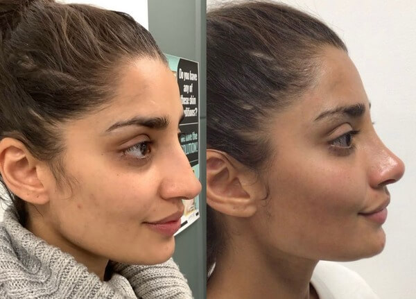 Natural-Looking Nose Job: Achieve Facial Harmony with Rhinoplasty 