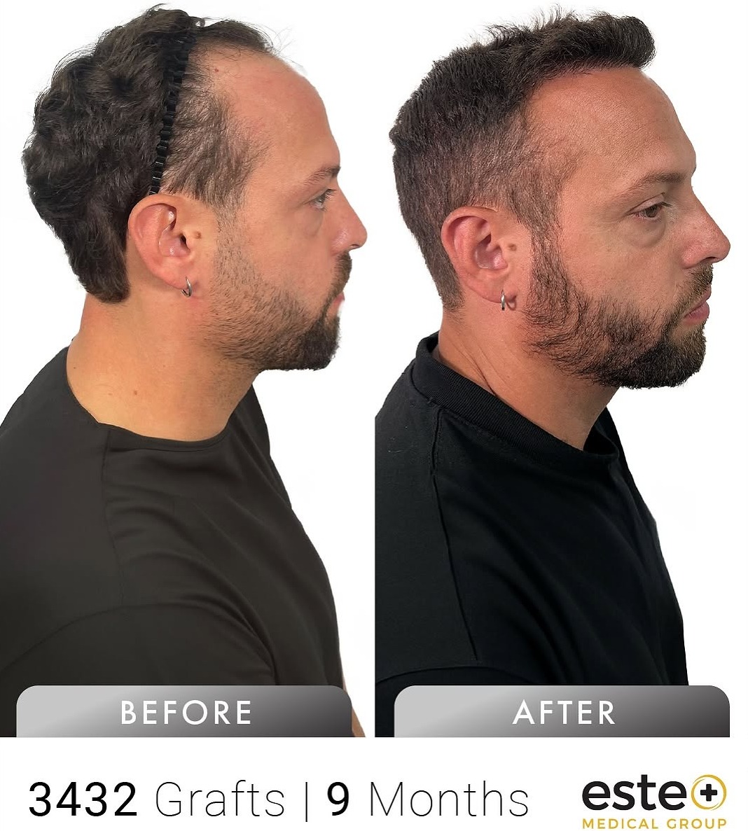 hair transplant before and after results