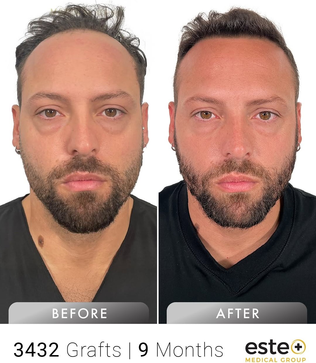 Hair Transplant before and after