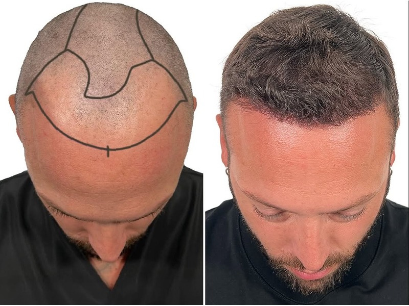Giuseppe Hair transplant results