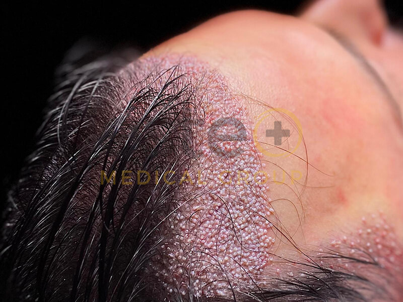 Hair Transplant Aftercare Support
