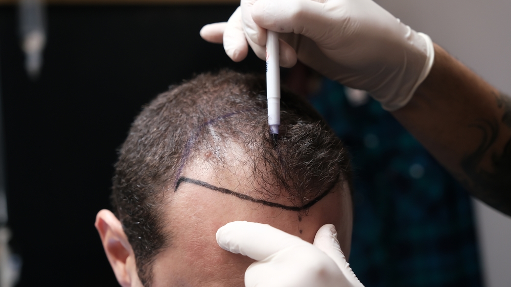 Hair Transplant Treatment in Turkey