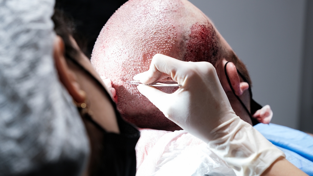 Hair Transplant Turkey