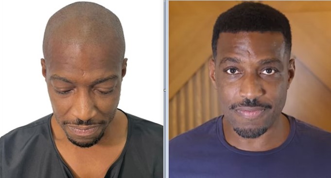 Hair Transplant before and after result