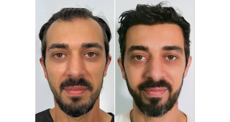 DHI Before and after Results