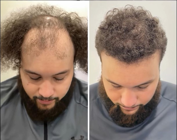 Connor Hair Transplant Results