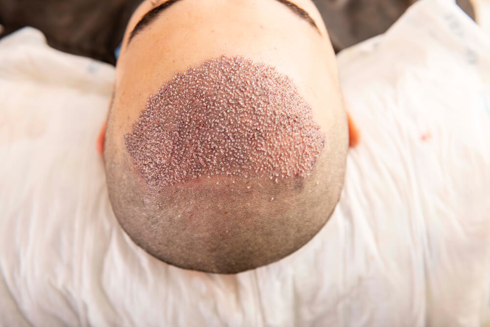 Is Hair Transplant painful