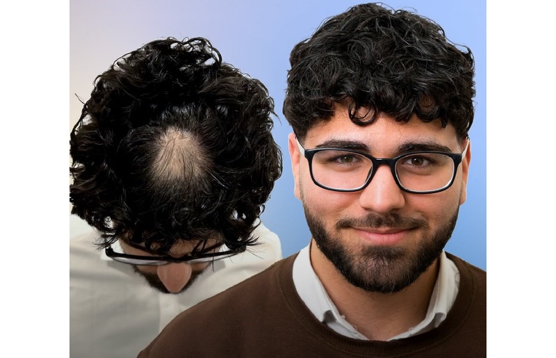 Azzy's Alopecia Areata Hair Treatment Result