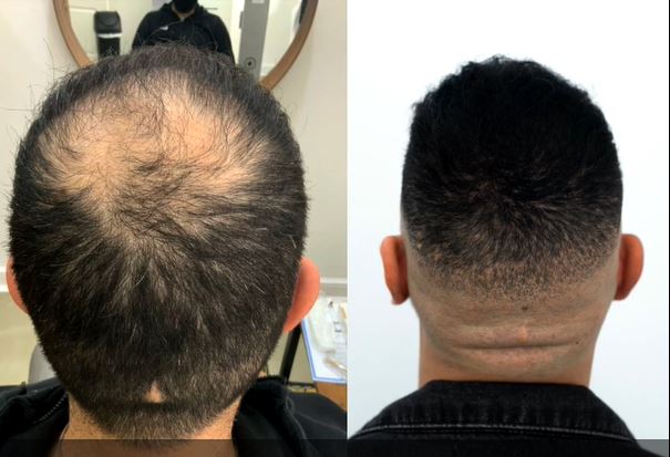 Hair Transplant results