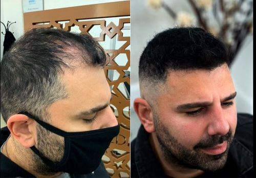 Loucas before and after results