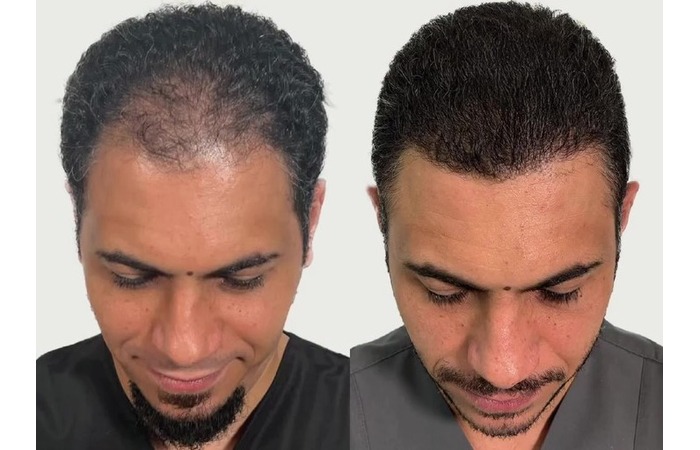 hair transplant before and after result