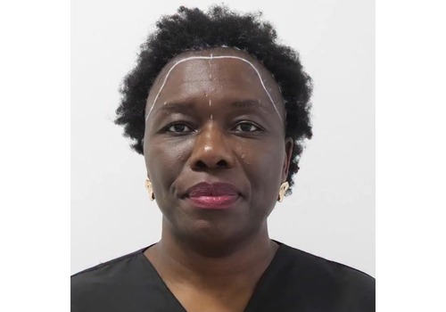 Yvonne 5 Months After Female Afro Hair Transplant