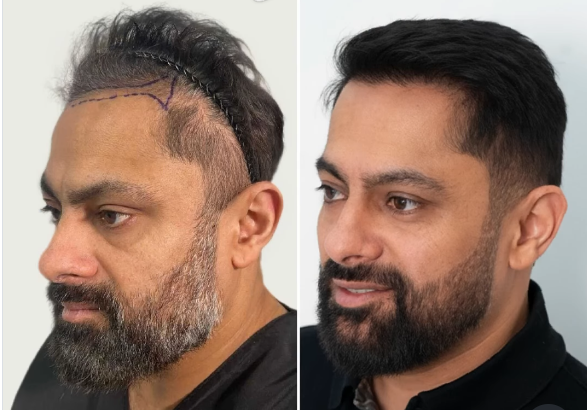 hair transplant result