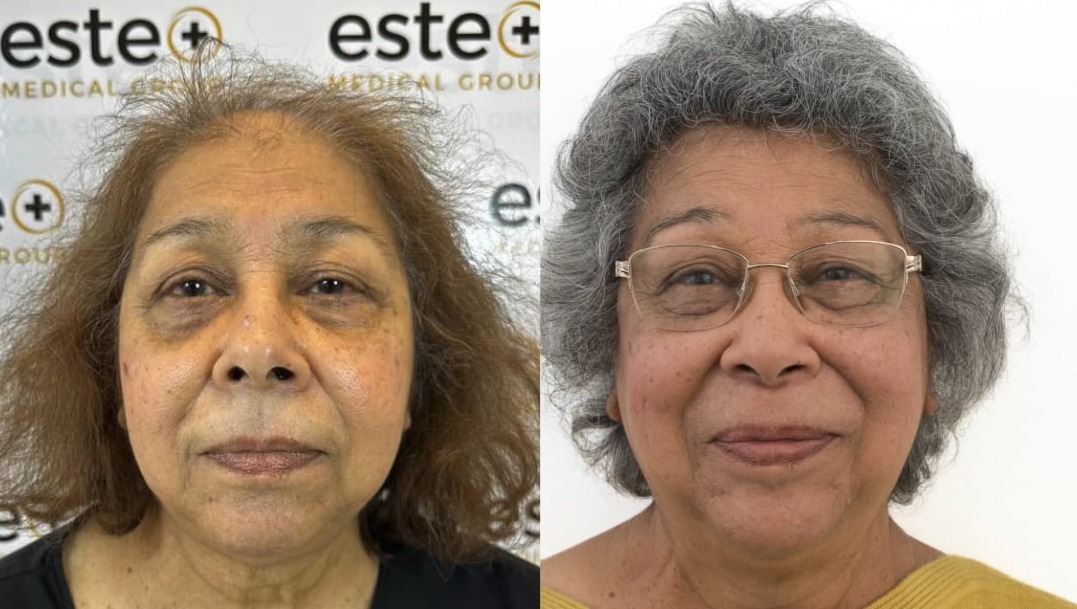 Hallema Shares Hair Transplant Results