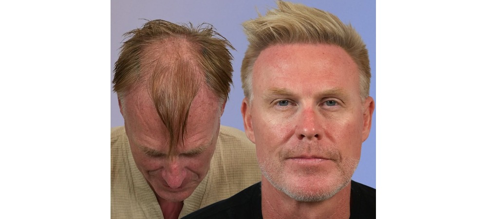Mark’s Este Hair Transplant in Turkey