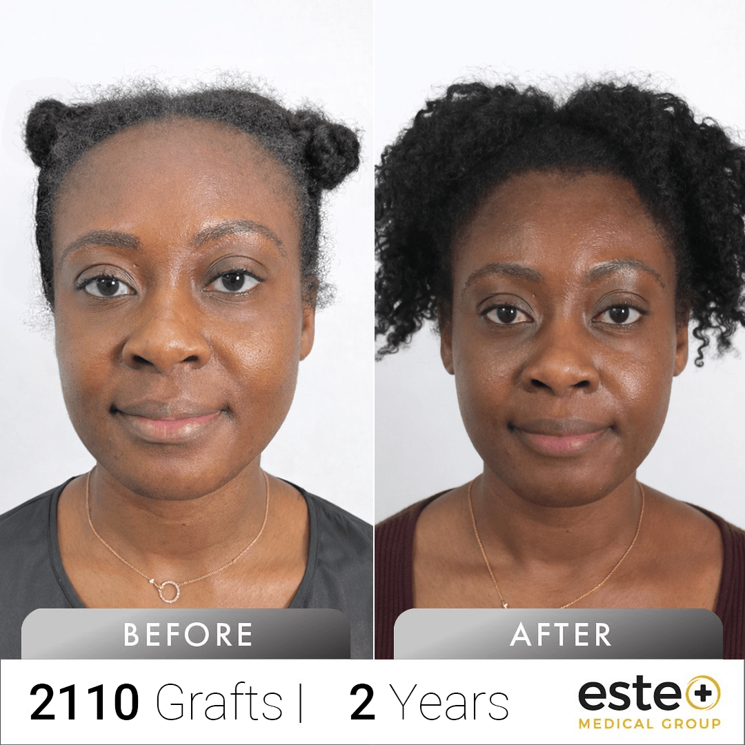 Natasha's Afro Hair Before & After Transplant Experience