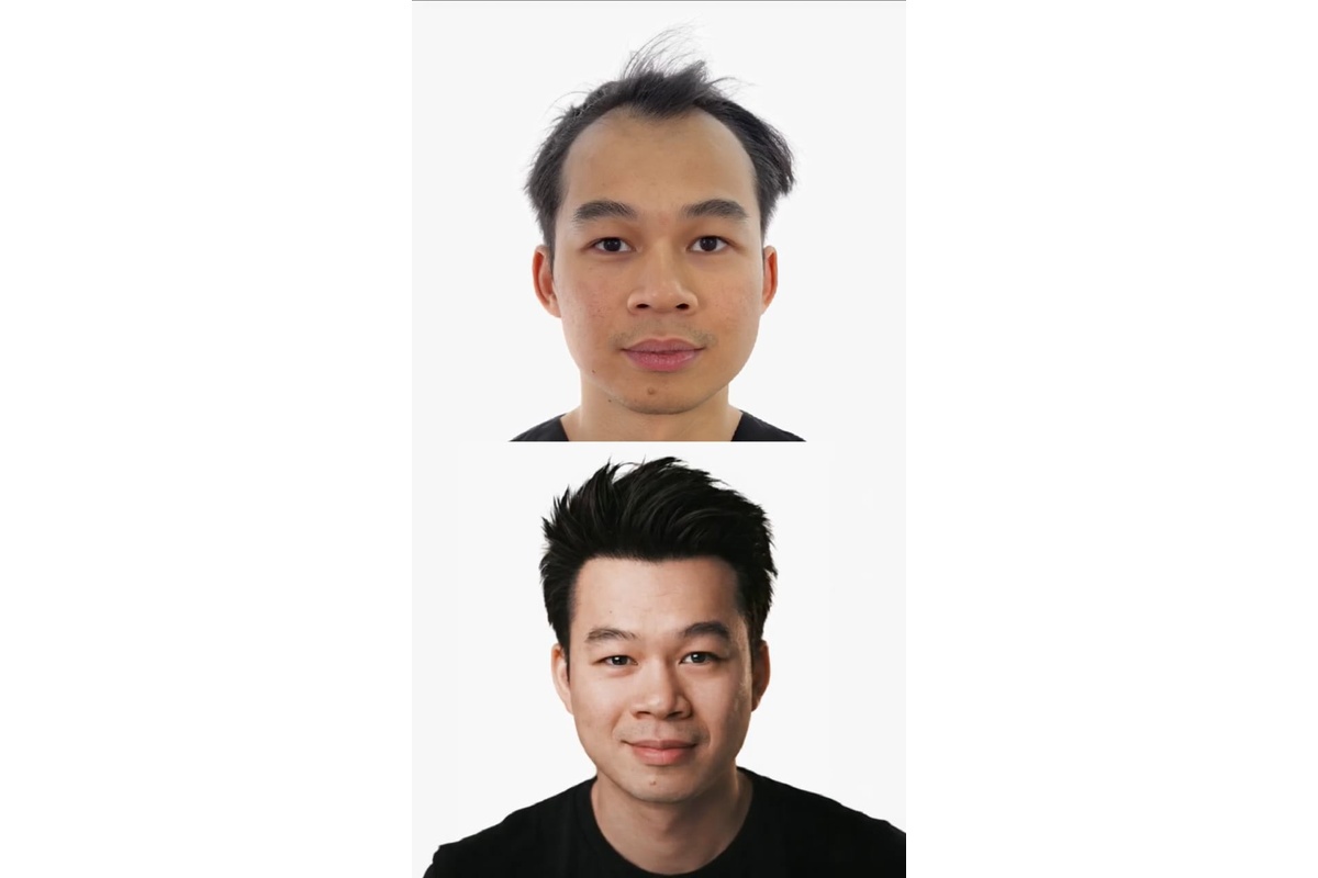 From Canada to Turkey. Jian Restores His Hairline with 3,220 Hair Grafts