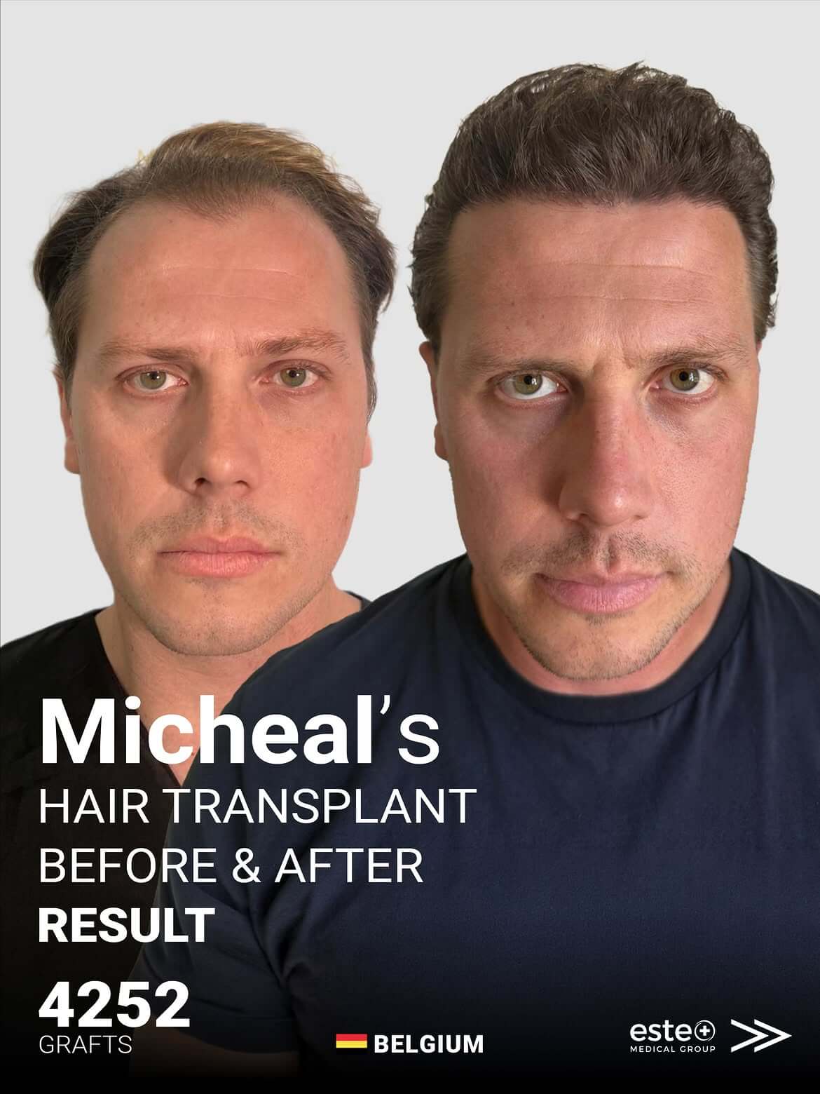 Belgium Client Micheal’s Turkey Hair Transplant Journey