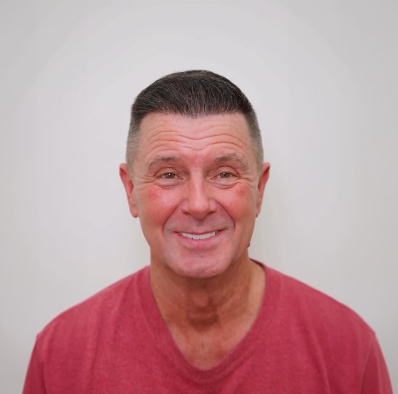 Ian’s Total Makeover in Turkey. Hair Transplant and Dental Work Results!