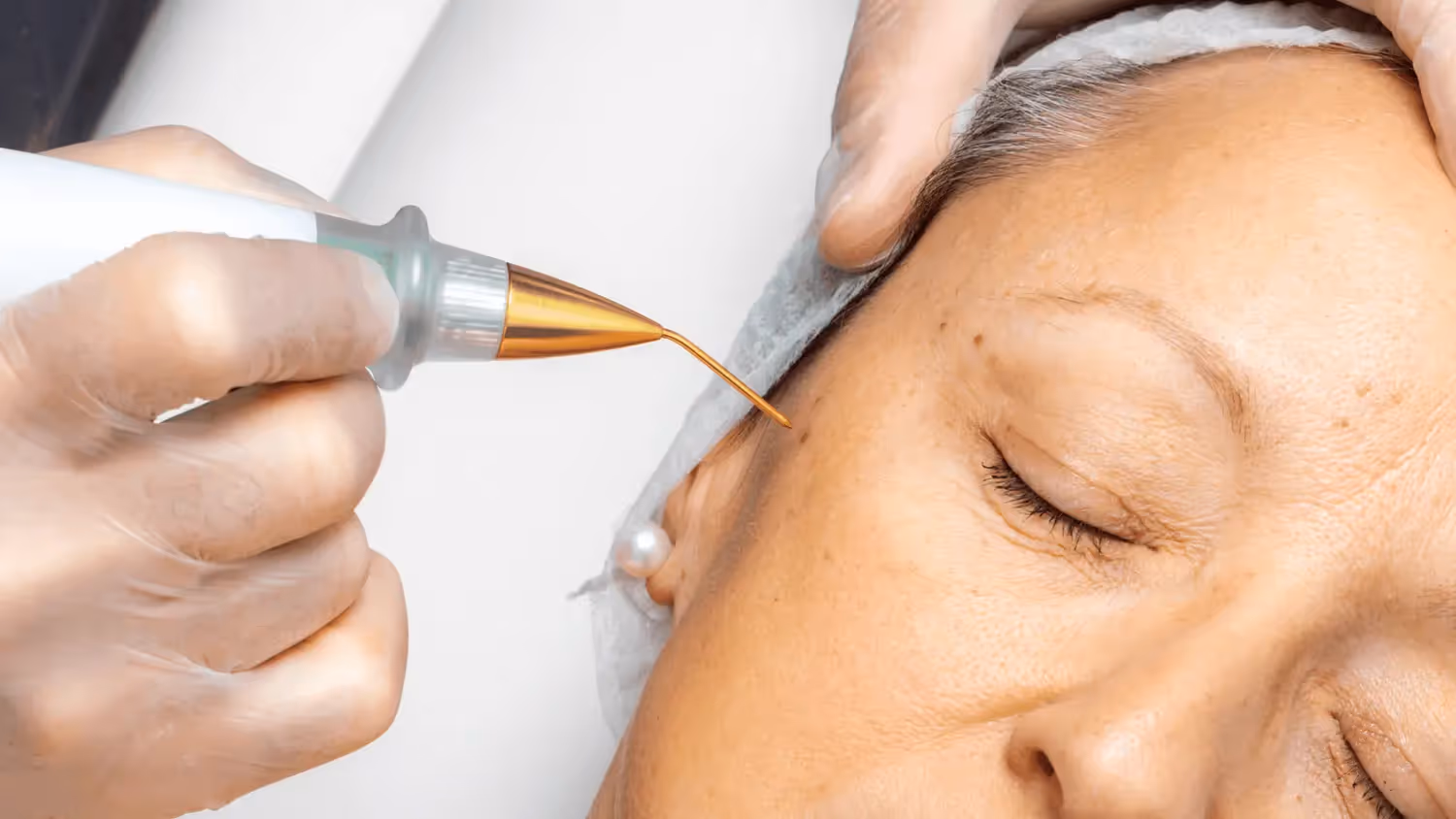 Plasma Fibroblast Therapy: What is Plasma Pen?