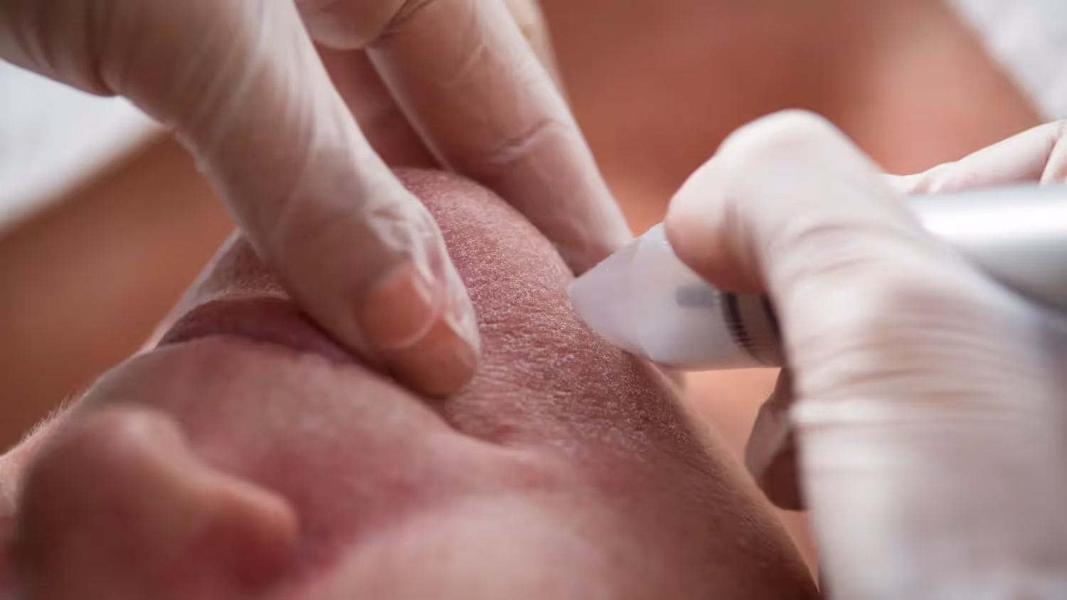 How Does Microdermabrasion Work? Exploring its Effectiveness & Profitability