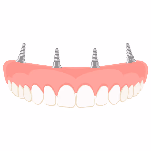 Full-arch dental implant in Lexington - Schroeder Cosmetic & Family Dentistry