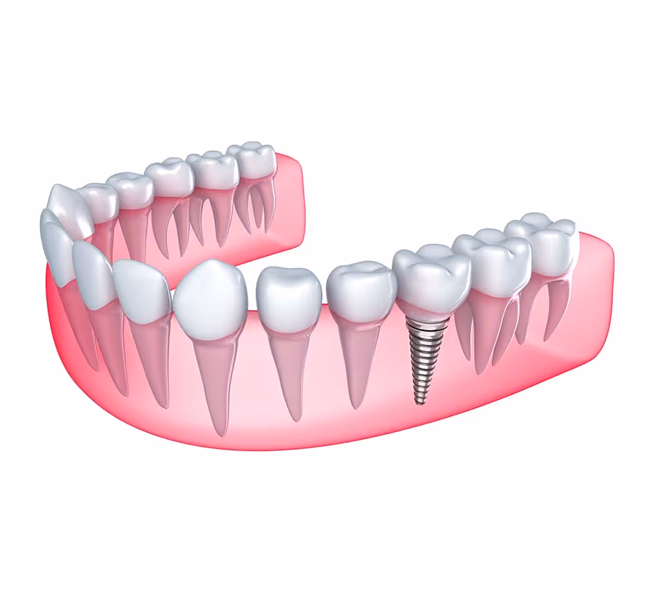 Single dental implant in Lexington - Schroeder Cosmetic & Family Dentistry