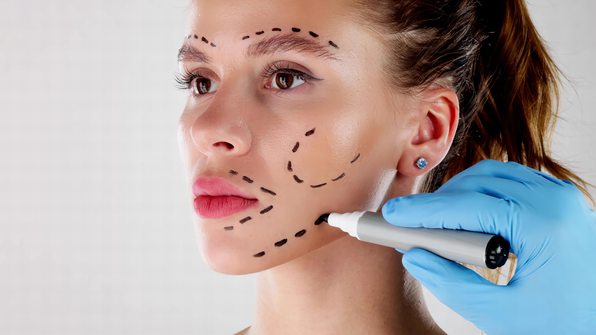 A woman being marked with in lines for a PDO thread lift.