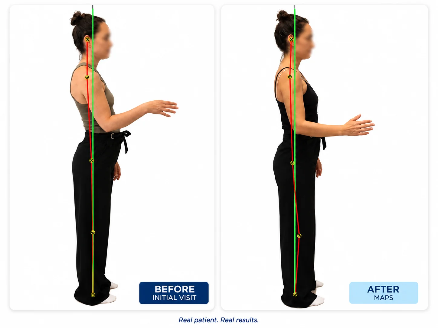 Before and after posture comparison showing reduced anterior pelvic tilt and lower back arch after the MAPS program