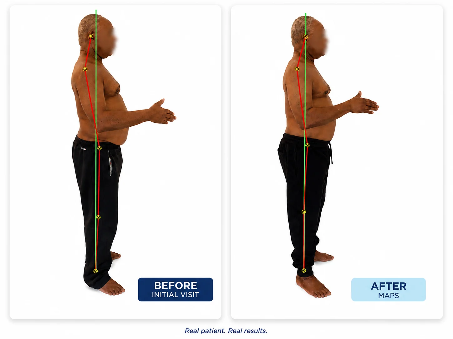 Before and after posture comparison showing reduced forward head posture and lower back arch after the MAPS program