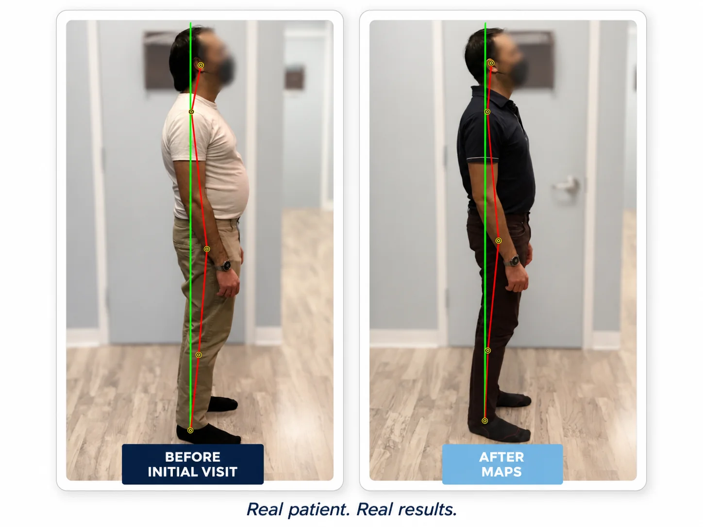 Before and after posture comparison showing reduced rib flare and a flatter stomach after the MAPS program