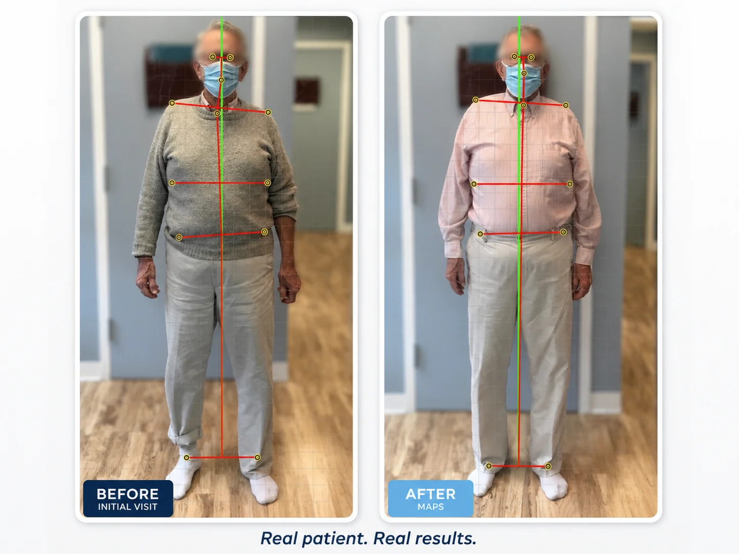 Before and after alignment comparison showing leveled shoulders and hips after the MAPS program