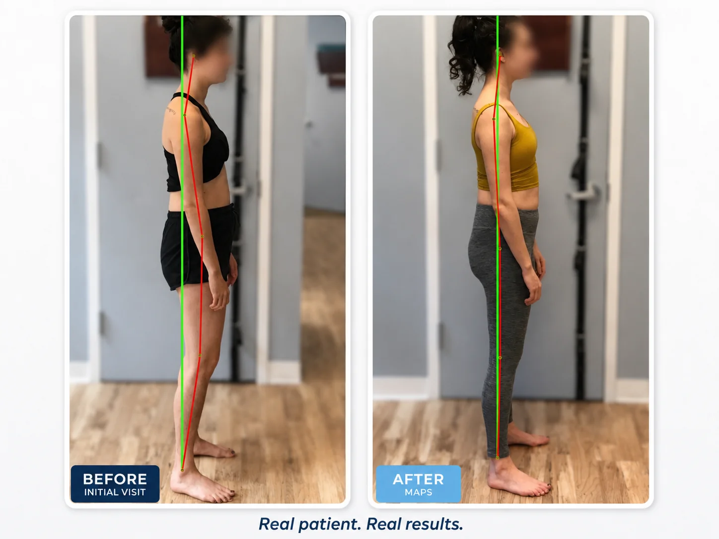 Before and after posture comparison showing reduced upper back rounding and forward head after the MAPS program