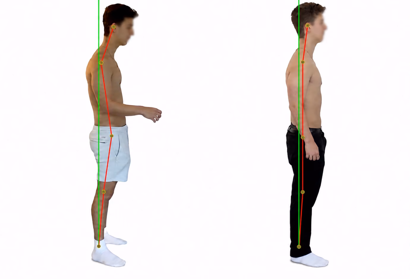 Before and after posture comparison of a real MAPS patient after three months
