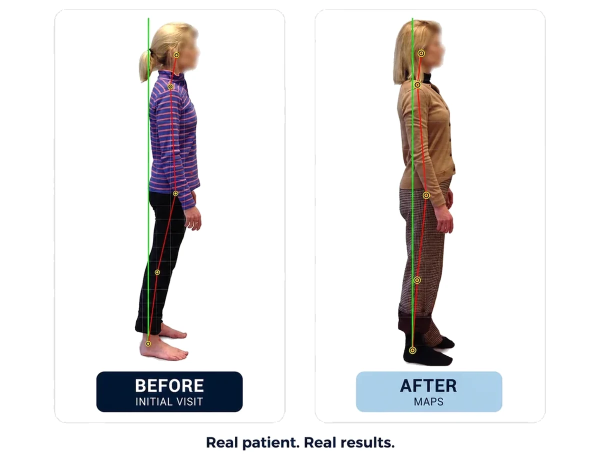 Before and after posture correction — real MAPS™ patient, pelvis realigned over the ankles