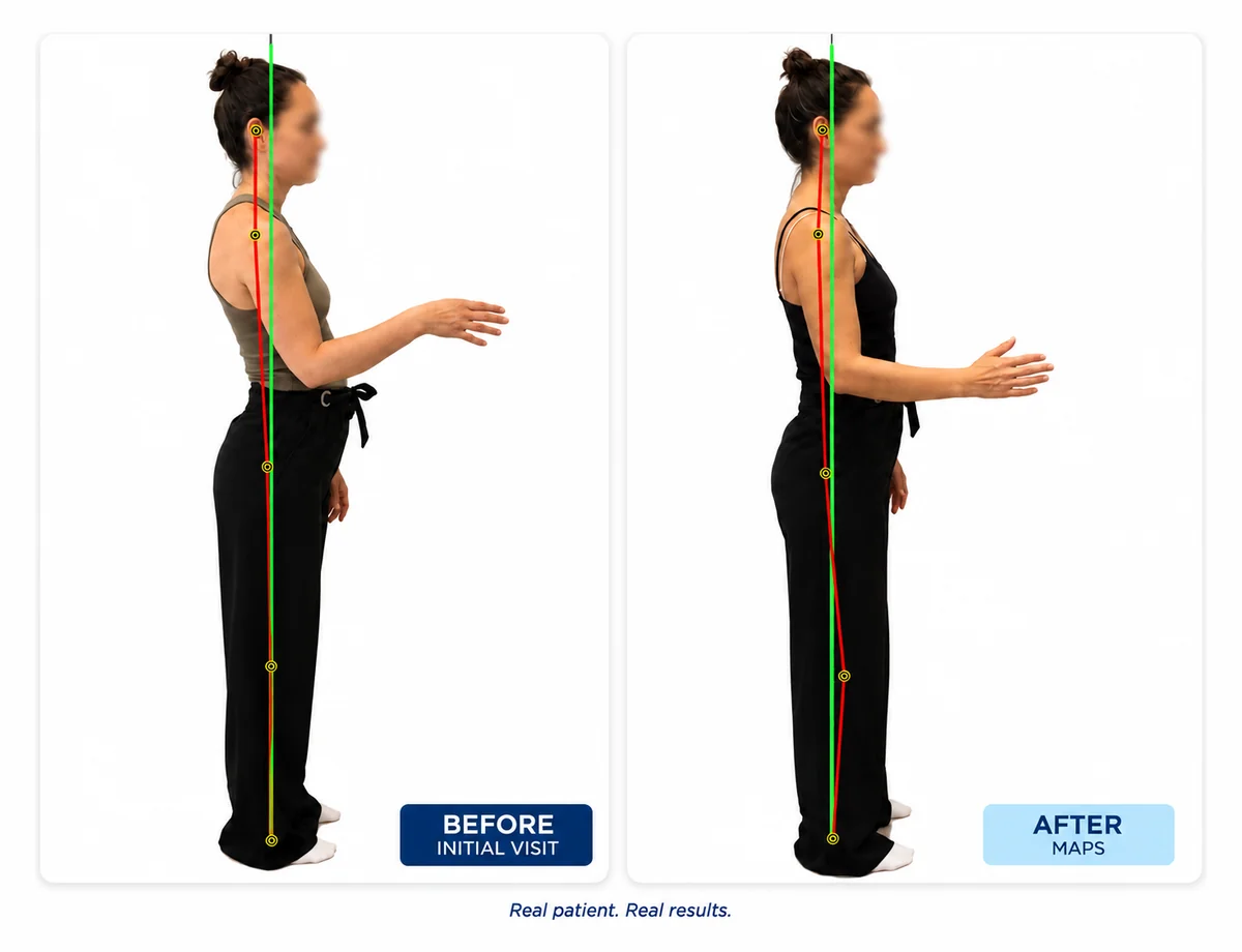 Before and after posture correction — real MAPS patient, pelvis returned to neutral from anterior tilt