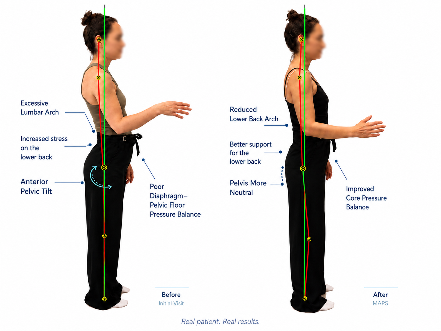 Before and after posture analysis showing anterior pelvic tilt, lower back stress and improved MAPS posture correction