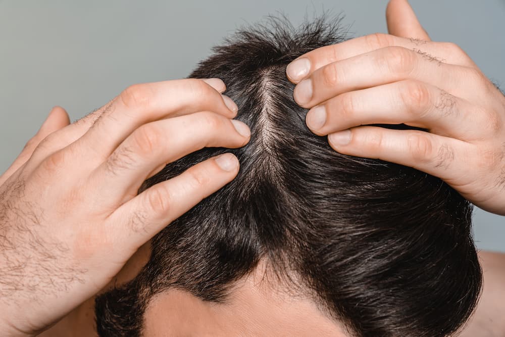 Close-up of thinning hair on a man’s scalp, illustrating professional hair restoration results.