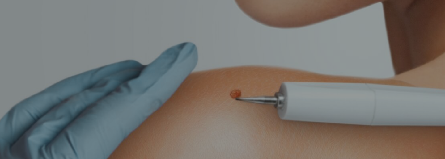 Gloved hands examining a mole on a patient's shoulder with a handheld device at Radiant Dermatology and Aesthetics in Greater Houston, Texas